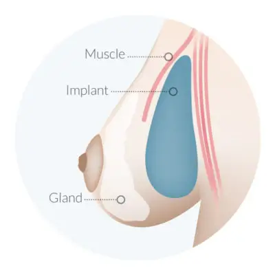 IMPLANT ÇIFT DÜZLEM POZISYONUNDA YERLEŞTIRILI