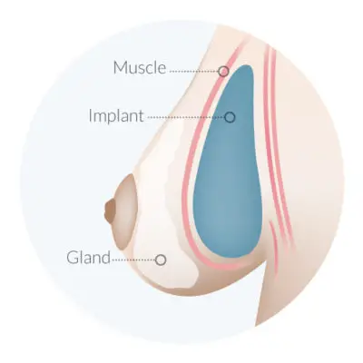 IMPLANT PEKTORAL KASIN ALTINA YERLEŞTIRILIR